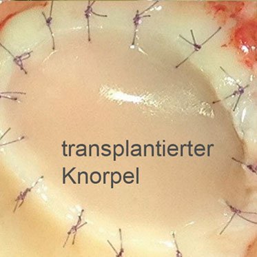 Knorpelzelltransplantation